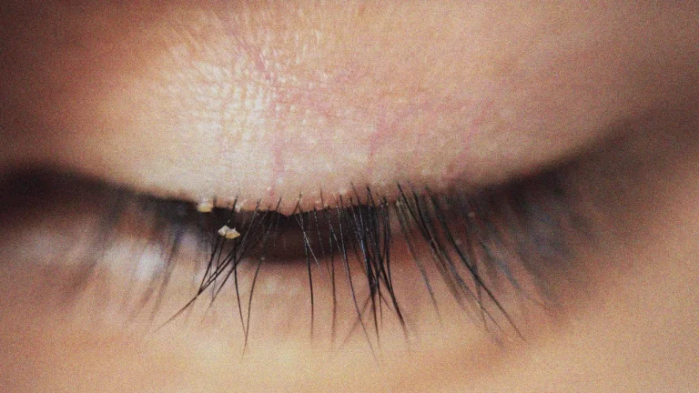 Eyelash Mites: Symptoms, Causes, and How to Treat Them